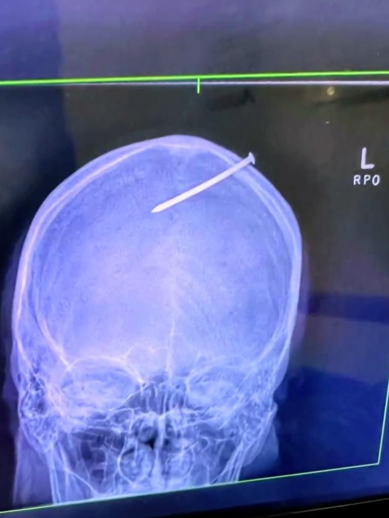 Sivan shared a horrifying picture of the X-ray his dad had before undergoing surgery to save his life. Picture: Channel 10.