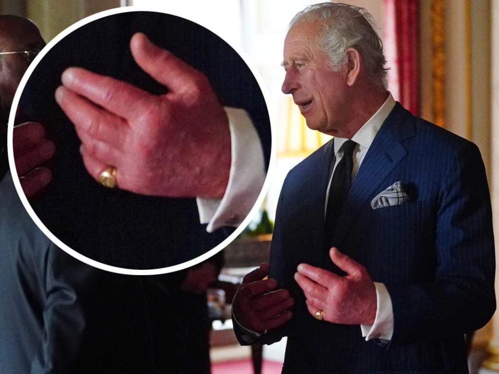 King Charles’ fingers drew attention after the death of the Queen. Picture: Getty Images