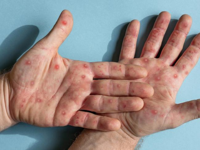 The disease causes fever, muscular aches and large boil-like skin lesions. Picture: Supplied