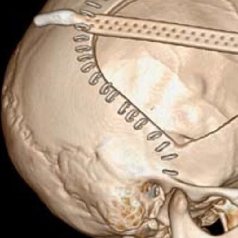 A scan of Mr McEwen’s skull. Picture: 60 Minutes