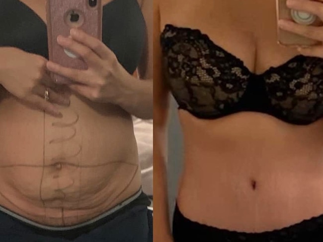 A before-and-after tummy tuck picture posted to Facebook