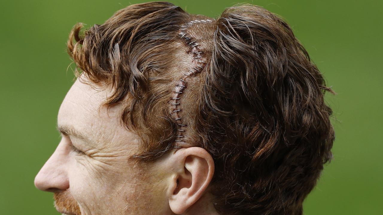 NCA. MELBOURNE, AUSTRALIA. September 16 , 2024. Geelong training at GMNBA Stadium, Geelong. Gary Rohan of the Cats with a head full of staples after operation to fix a fracture in his scull during todays session . Pic: Michael Klein