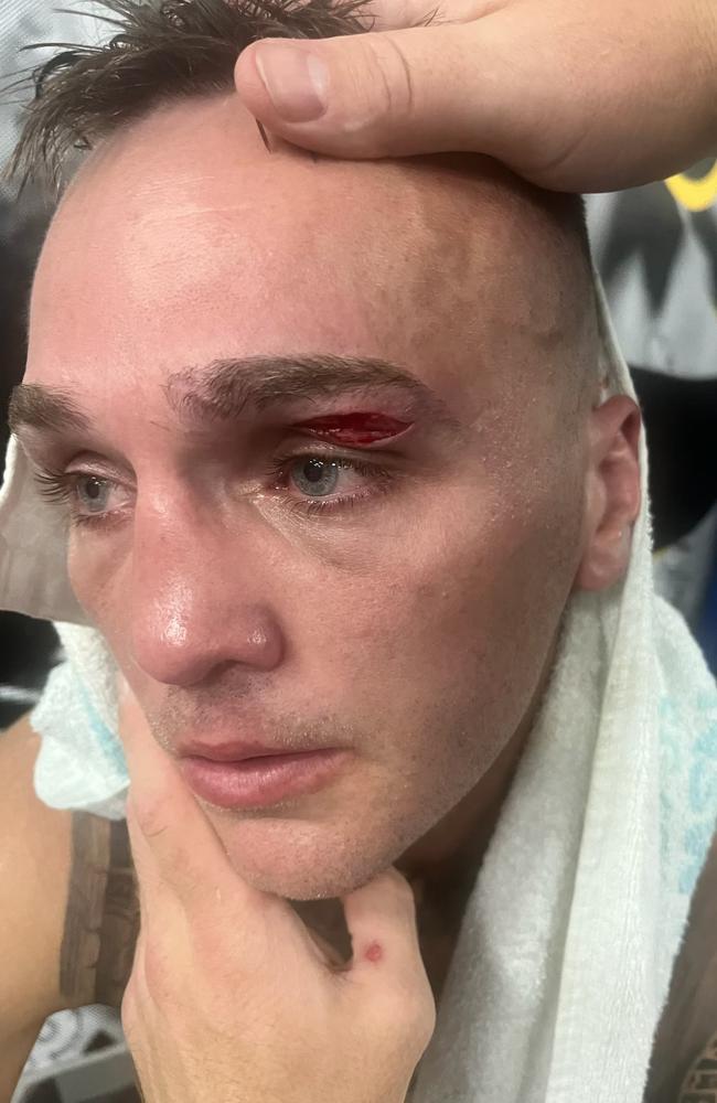 Sam Goodman's gruesome eye injury sustained in training for his world title fight. Photo: Supplied