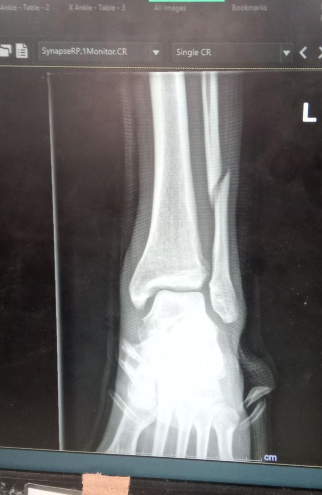 An X-ray of the man's broken leg after gang violence in Peppimenarti. Picture: Supplied