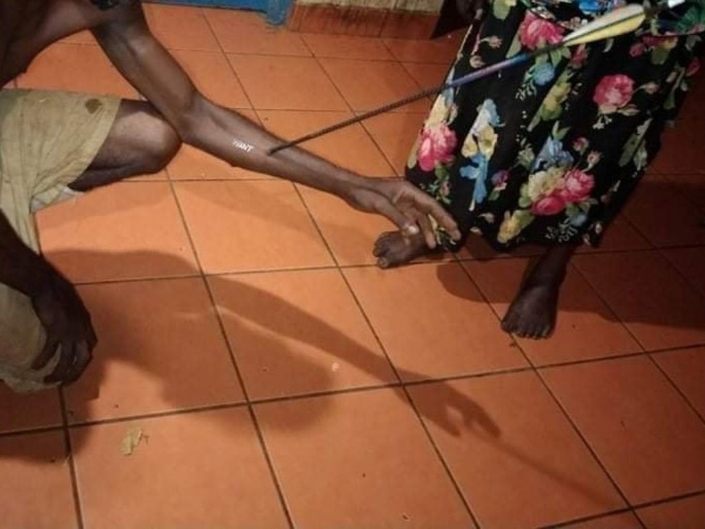 Image of a man impaled by an arrow following a recent skirmish in Wadeye.