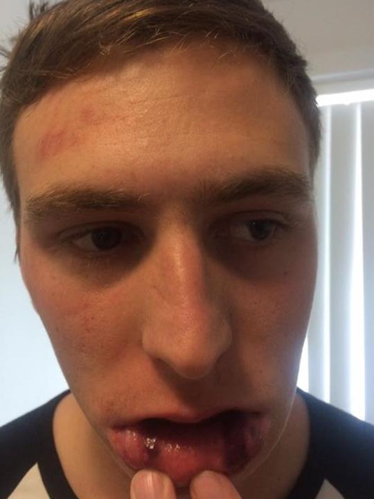 Roopena Football Club player Ben Auld’s injuries after an on-field incident in his club’s clash with Weeroona Bay Football Club on April 29. Picture: Supplied