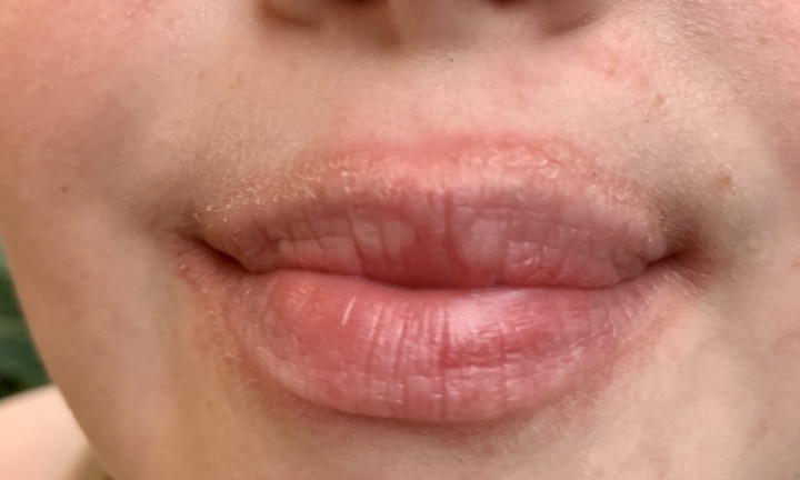 why-are-my-lips-red-and-stinging-ownerlip-co