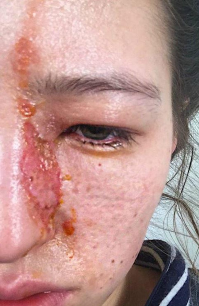 The woman's burns on her face.