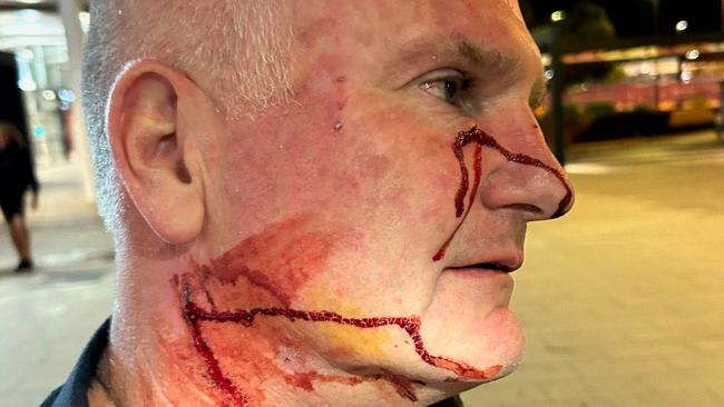 An AFP officer needed hospital treatment after being stabbed in the face and neck with a pen allegedly by a Jetstar passenger in Perth. Picture: Australian Federal Police