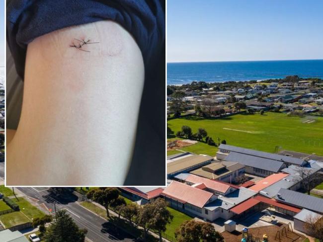 A deep 3cm-long laceration caused to a Year 6 student at West Ulverstone Primary School accidentally by a knife on August 14, 2023. Picture: Supplied