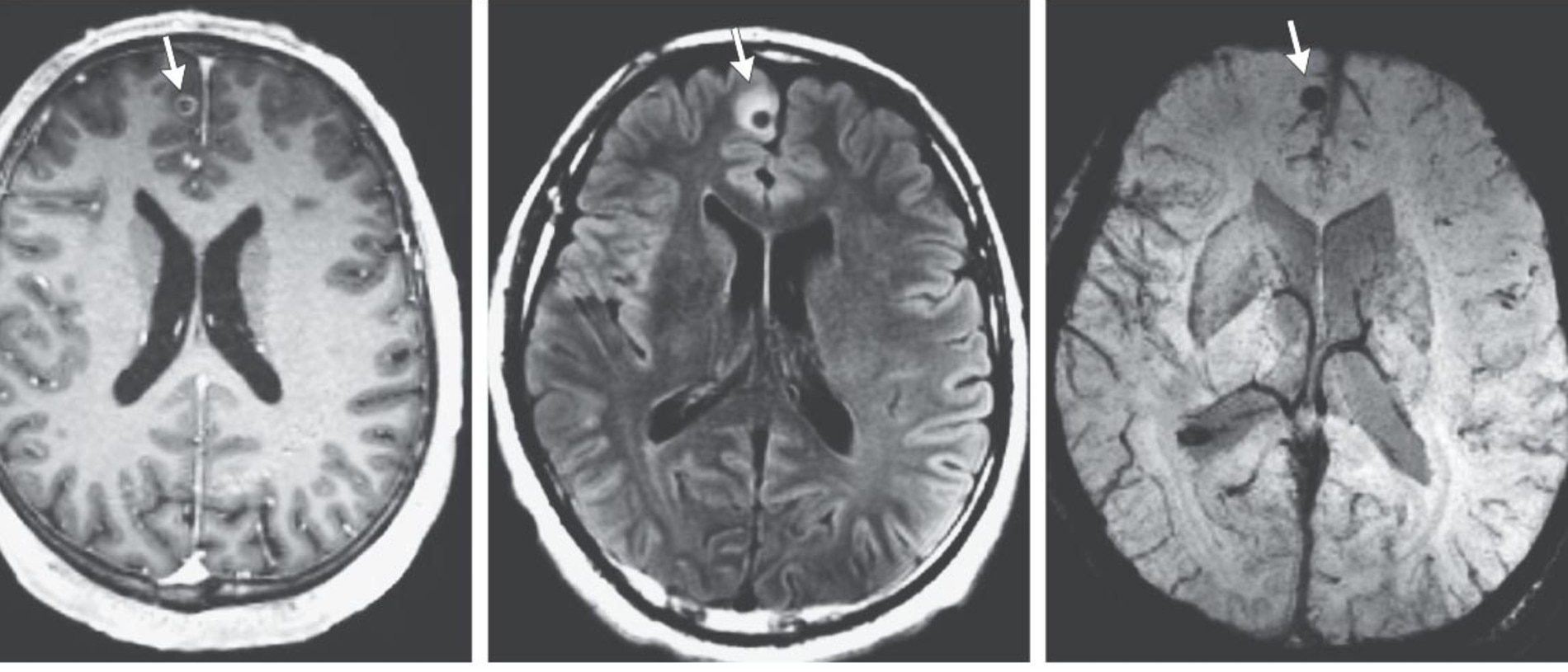 Man hospitalised with seizures discovers tapeworm was in brain for decades. Picture: Facebook/TheNew England Medical Journal