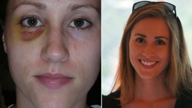 Colbie Holderness was Rob Porter's first wife. She is shown at left with a black eye she says Mr Porter gave her. Picture: Supplied