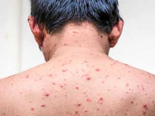 Back side of a man who having varicella blister or chickenpox ,isolated on white. Picture: viiwee