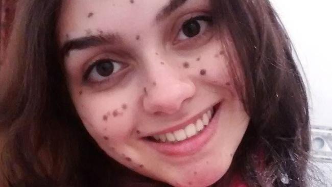 Beautiful from birth: Bullied for birthmark on her face but that