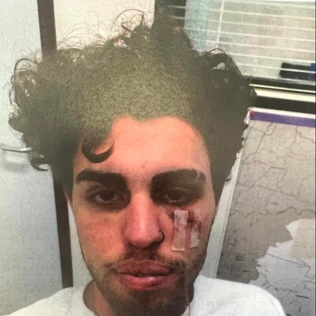A photo of the victim's injuries was shown to Magistrate Pamela Dowse in the Southport Magistrates Court.