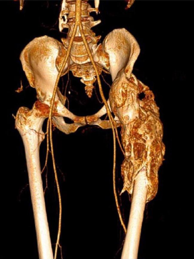 Scan of hip with Neurogenic Heterotopic Ossification (NHO). Picture: Stuart Sherwin