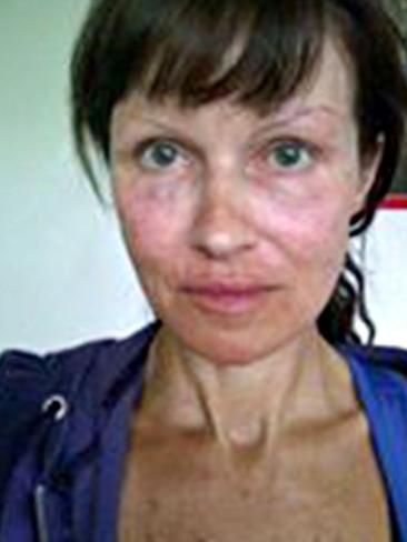 Bee after having dermabrasion.