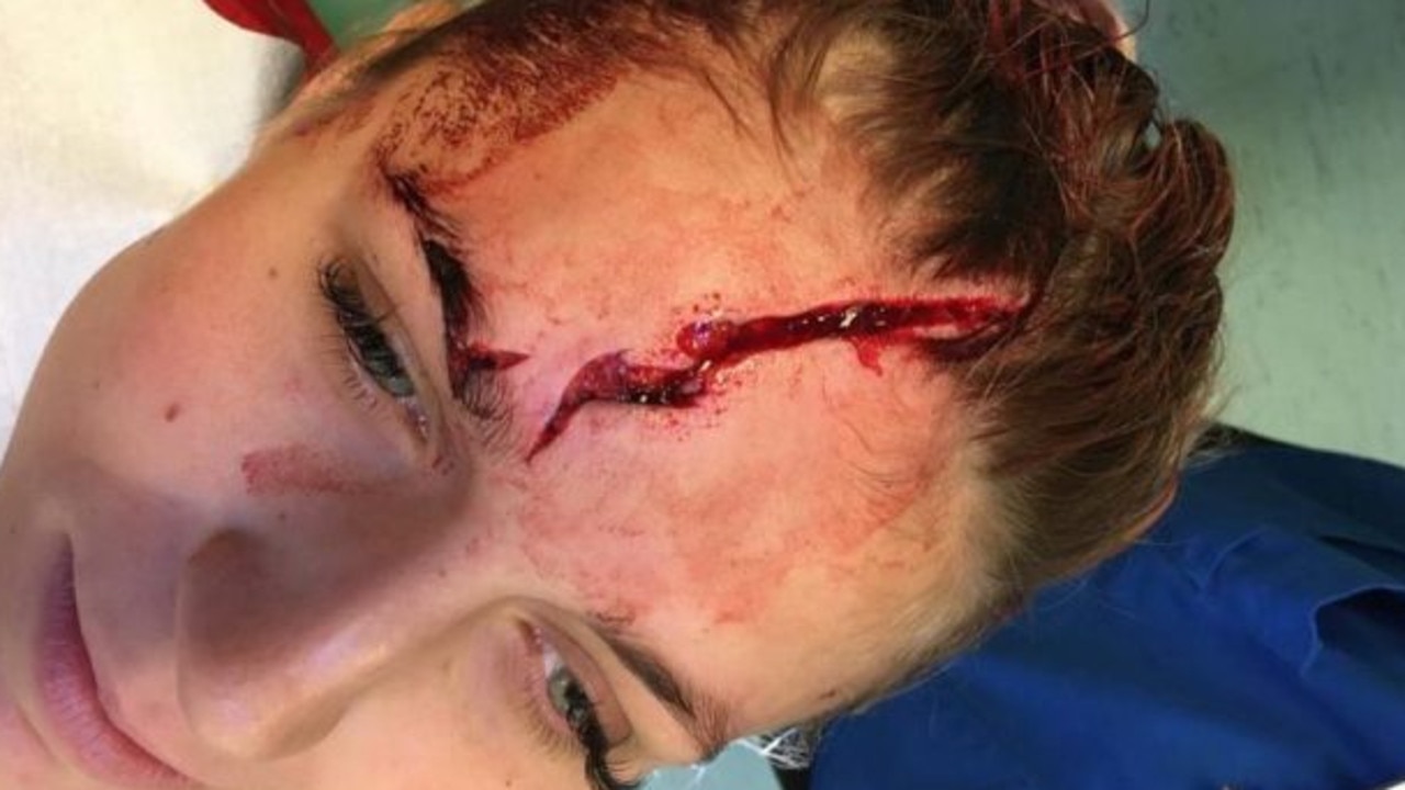 Fran Kitching sustained a gruesome head injury in a training ground incident