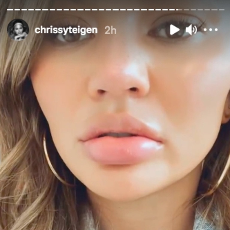 Chrissy Teigen Blames Orange For Majorly Swollen Lips The Advertiser 