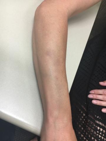 The bruises on Kelly Landry’s arm will be tendered to court.