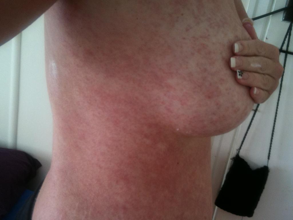 Vicki’s rash spread rapidly across her body, including her arms and legs.