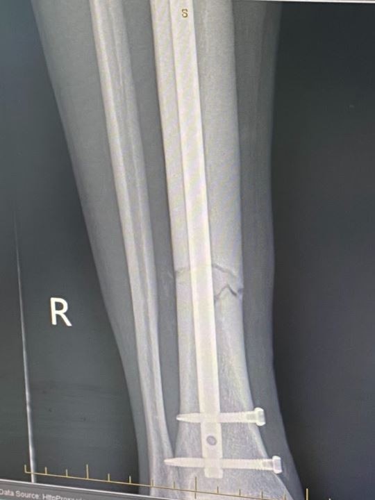 An X-ray of Walker’s leg showing the surgical repairs.