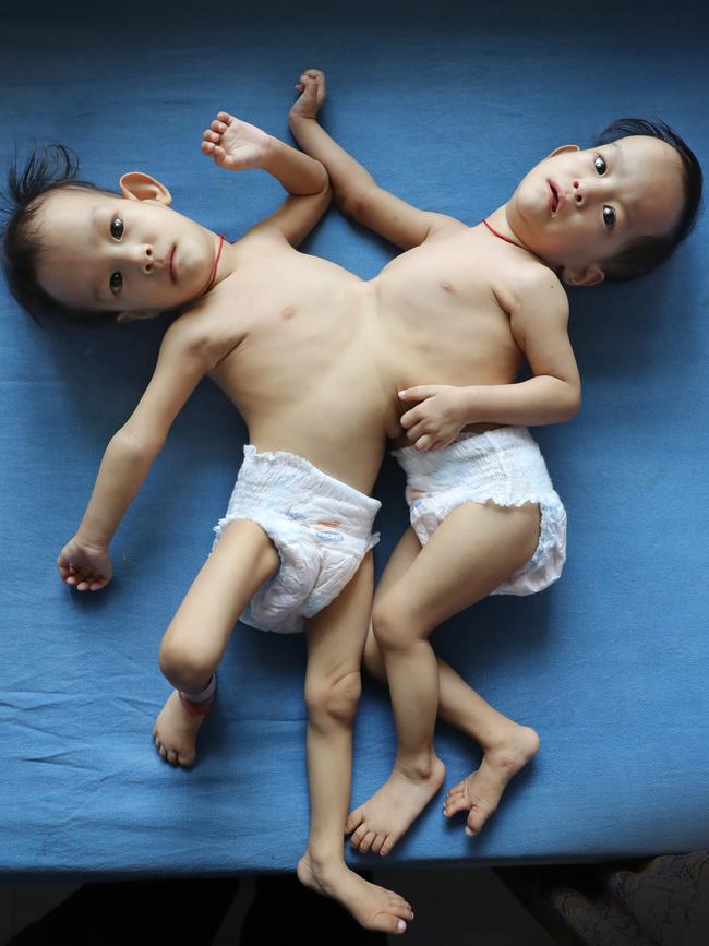 Conjoined twins Nima and Dawa, pictured at 14 months old, made the arduous trip from a rural area of Bhutan to Melbourne for life changing surgery at the Royal Children’s Hospital. The pair won the hearts of Victorians and returned home happy, healthy and active. Picture: Alex Coppel