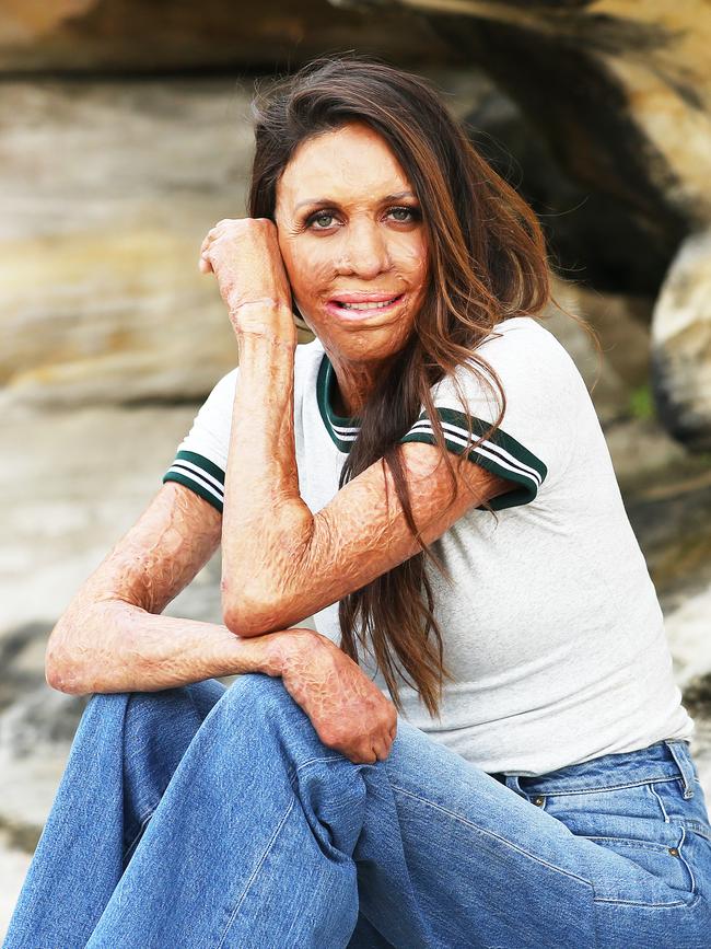 Turia Pitt is not afraid to show her scars to the world. Picture: Rohan Kelly