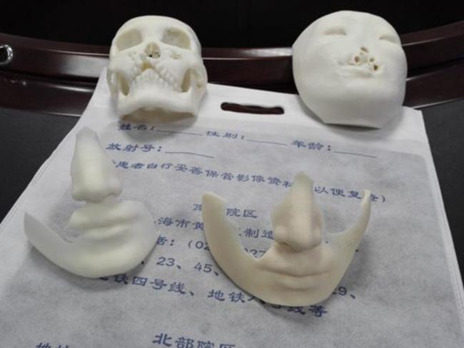 Doctors used 3D printing technology to help restore Jin Qi’s face. Picture: Xinhua