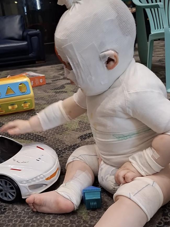 Baby Luka has undergone multiple surgeries after the attack, which his mum said left his skin “peeling off”. Picture: Supplied