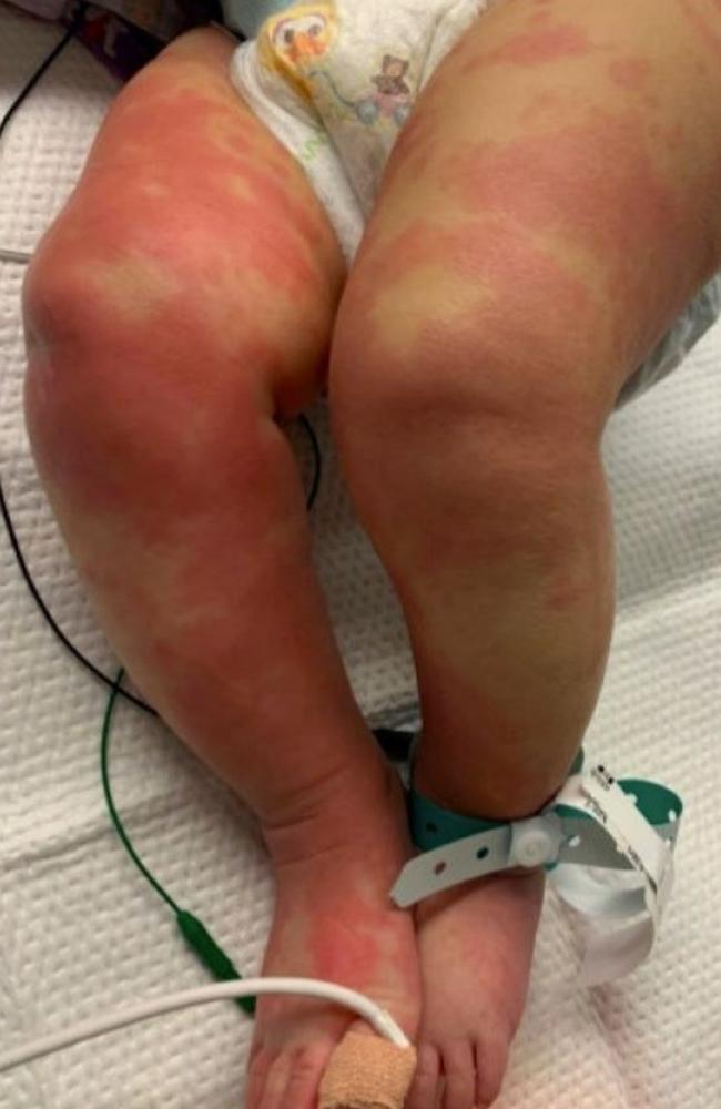 The six-month-old baby girl's legs were covered in a red, bumpy rash – believed to be Kawasaki disease