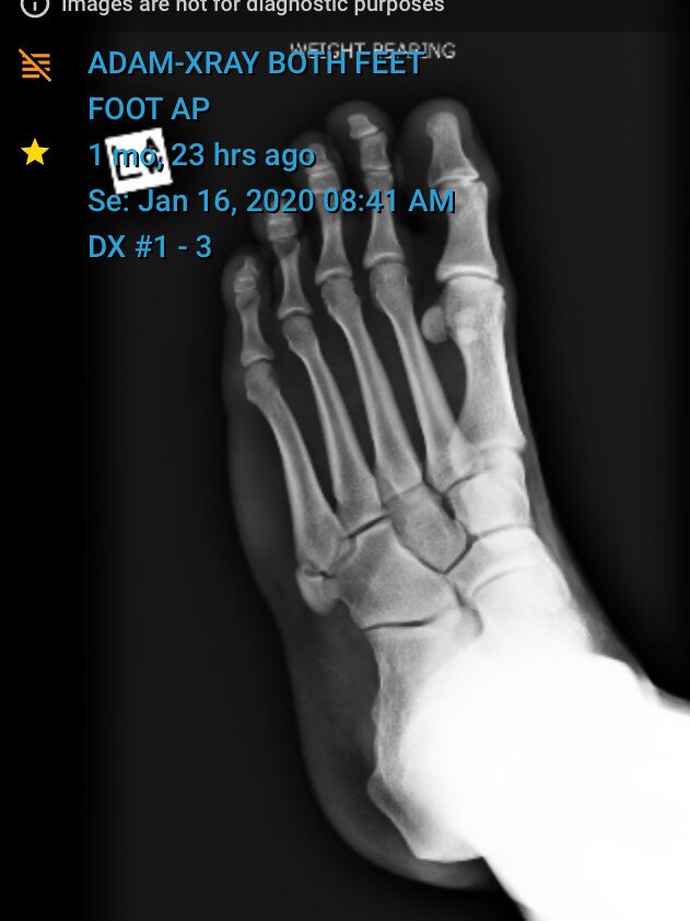 X-ray of Bradman Best's foot.