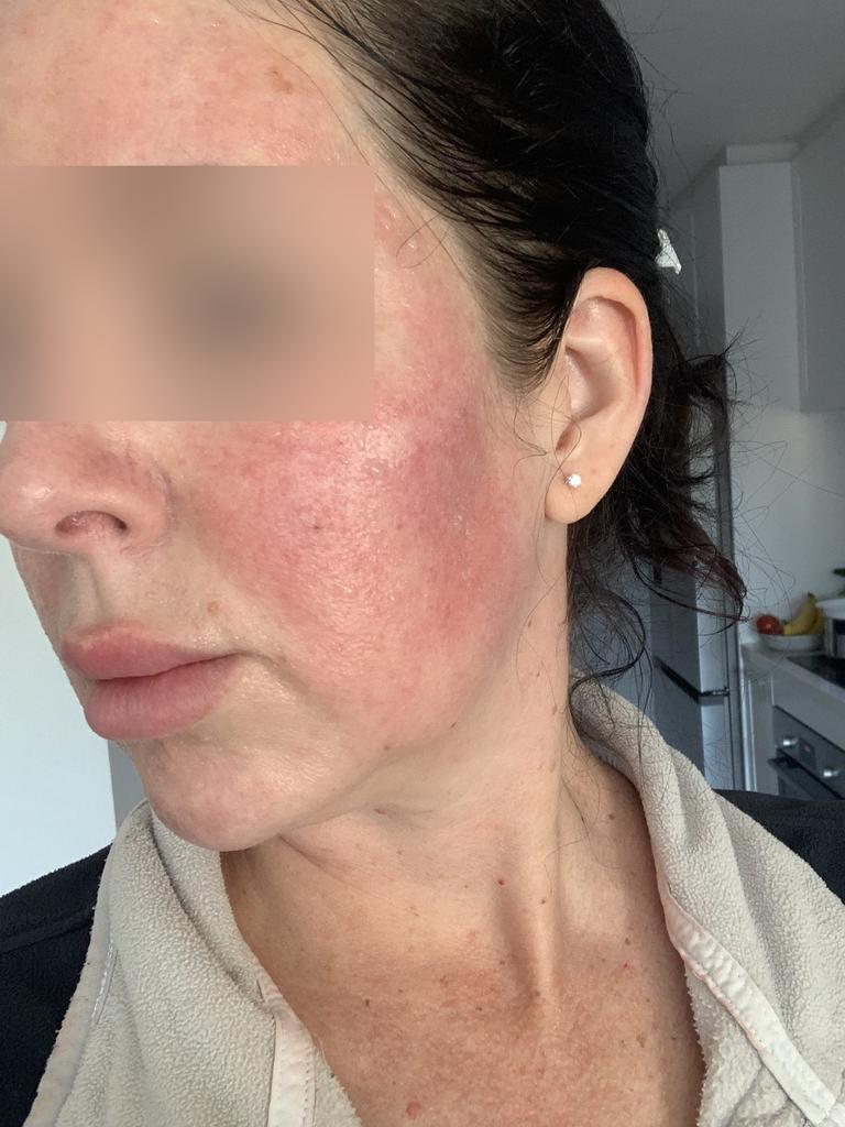 Sarah’s skin on day three after the procedure. Picture: Supplied