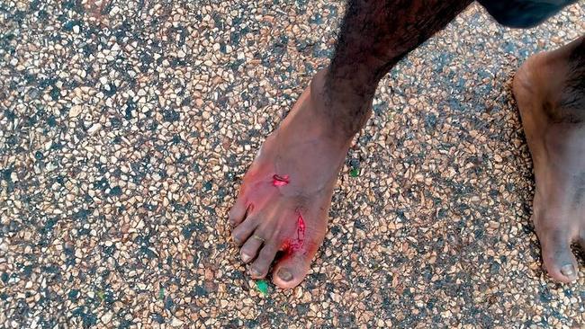 Dennis was treated for the bite at a Kalkarindji clinic. Picture: Supplied.