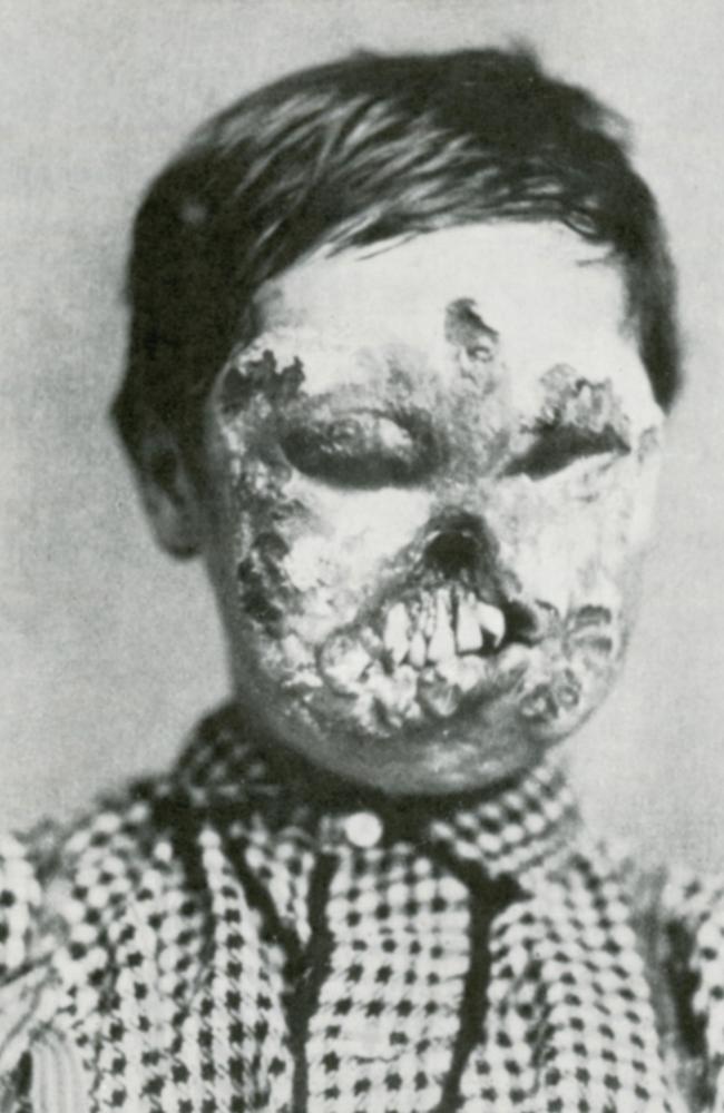 A child with severe facial deformities from contracting the disease.