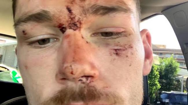 Canberra Raiders player Tom Starling after an incident with police on the Central Coast. Picture supplied