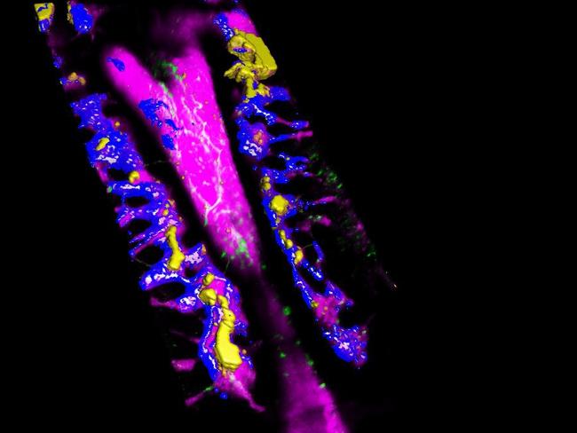 This microscopic image shows bone marrow being invaded and populated by (yellow) leukaemia cells. Picture: Edwin Hawkins/Delfim Duarte/Imperial College London.