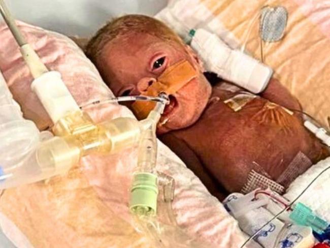 This baby was 14 weeks early… You won’t believe her today