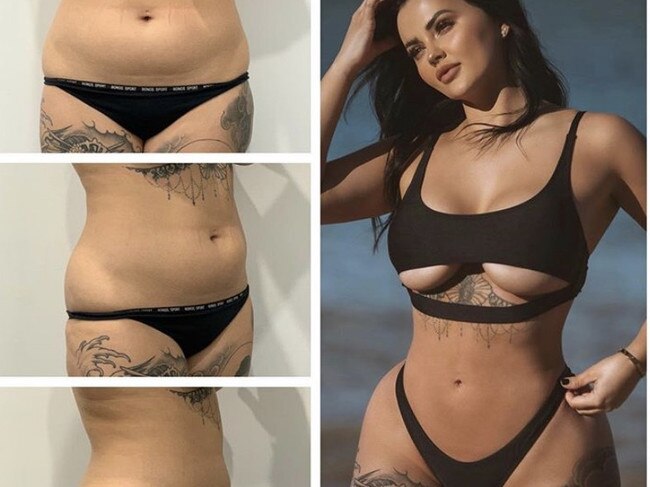 Renee Gracie before and after a Brazilian Butt Lift. Photo: Dr Kim Mitchell from Cosmos Clinic