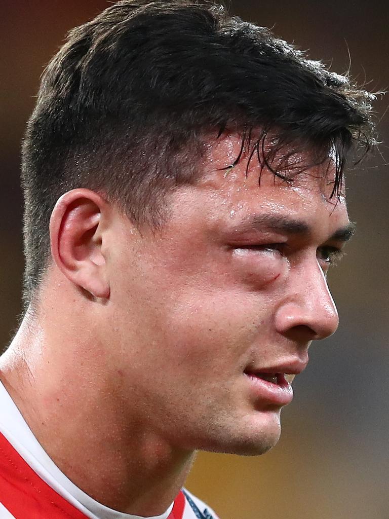 Joseph Manu’s gruesome facial injury (Photo by Chris Hyde/Getty Images)