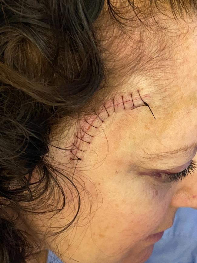 She was forced to recover from brain surgery in a Brisbane hotel. Pictures: supplied