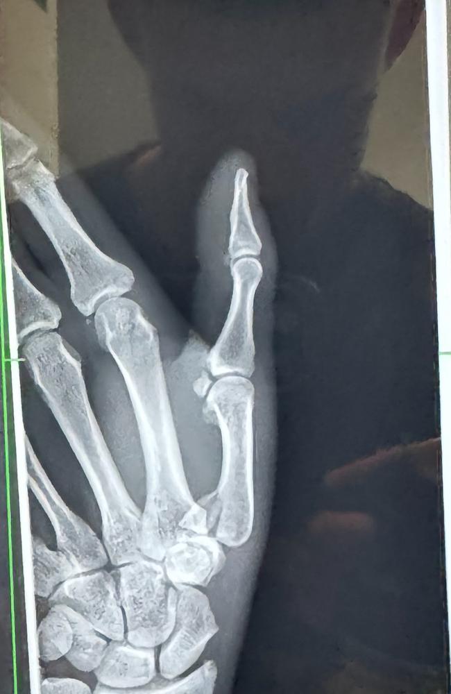 An X-ray of Garside’s thumb.