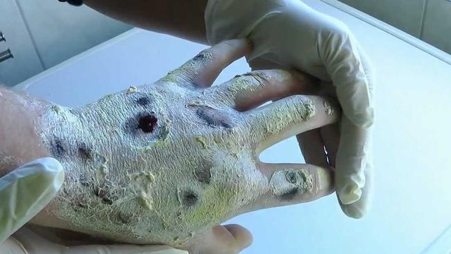 Krokodil Skin, Effects Causes and Treatments - Pictures