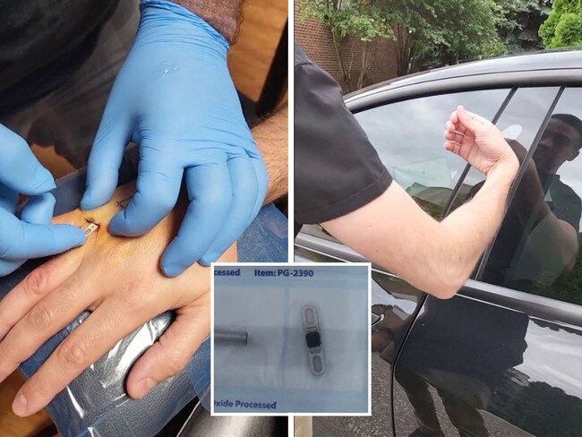 Man has Tesla keys implanted in his hand.