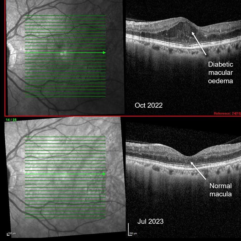 Before and after eye examination photos of Sujatha Rice’s eye problem.