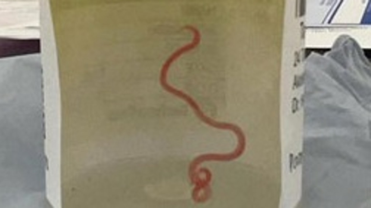 It's the world's first known case of a roundworm from a carpet python infecting a human. Picture: ANU