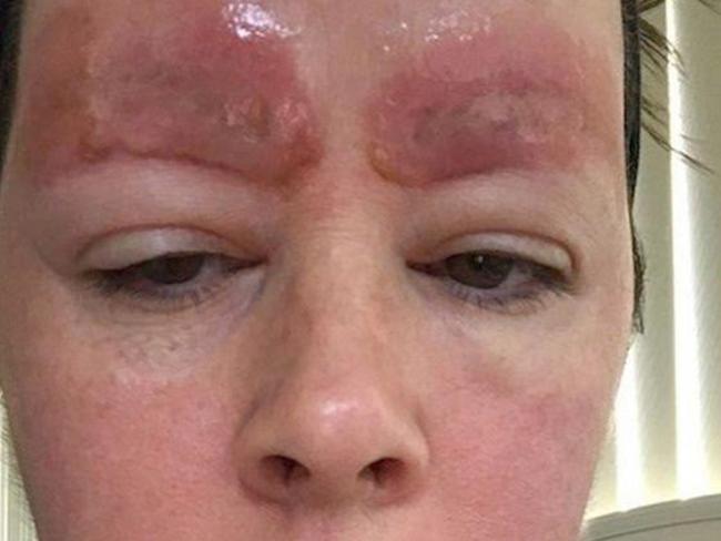 Melbourne mum Amanda Coats claims her skin fell off after having her eyebrows tattooed.