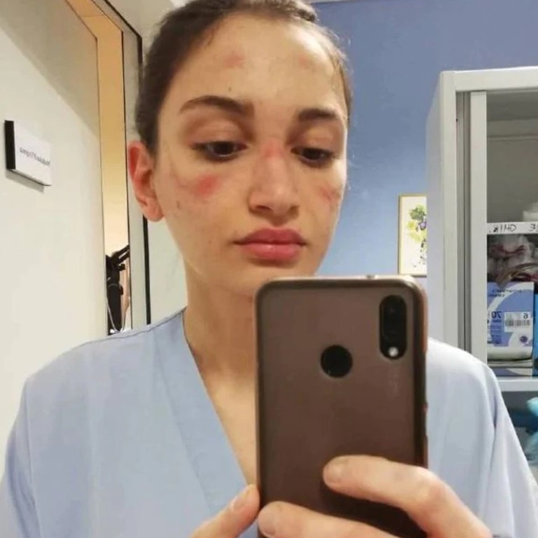 This photo of Italian nurse Alessia Bonari went viral last year. It shows how PPE had left her bruised and injured after working a long shift. Picture: Instagram/Alessiabonari