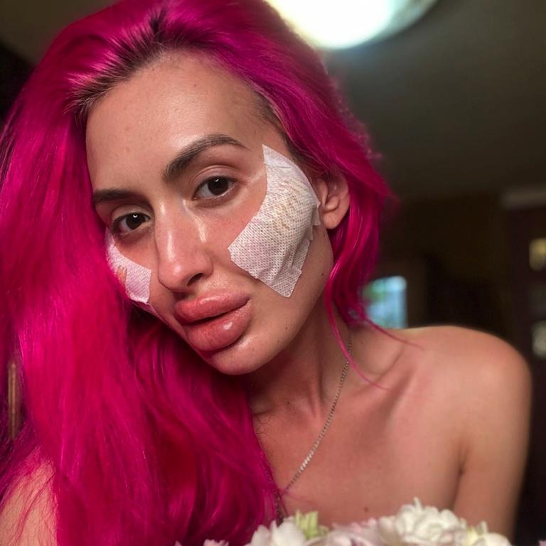The model poses following one of her procedures. Picture: Instagram