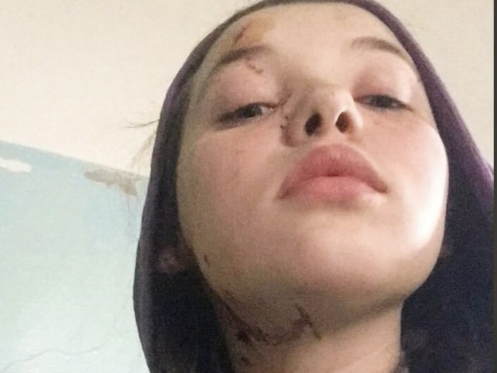 Kira Obedinsky was injured while fleeing Mariupol.